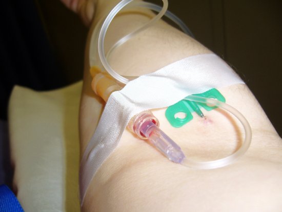 infusion